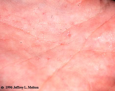 Example of 'palmar keratosis' (pit).