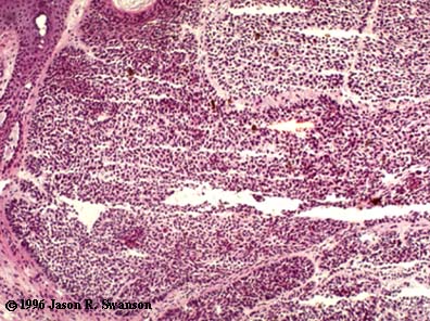 Pigmented Basal Cell Carcinoma Photomicrograph