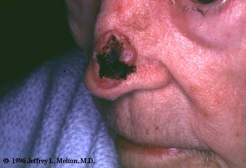 Basal Cell Carcinoma Of The Nose