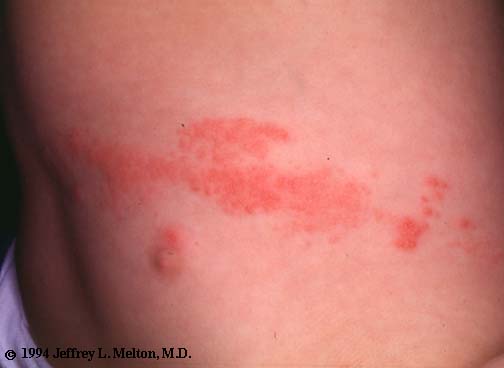 sacral herpes