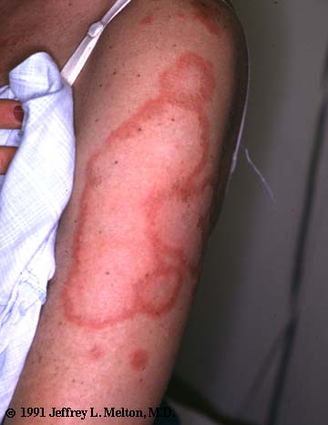 Subacute Cutaneous Lupus