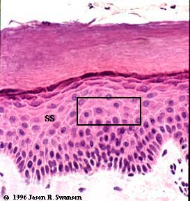 cancer of stratum spinosum cells cancer of stratum spinosum cells