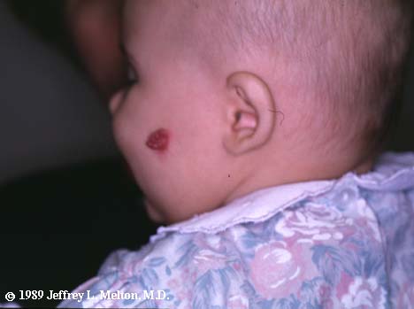 hemangioma of the Face hemangioma on face. hemangioma of the Face