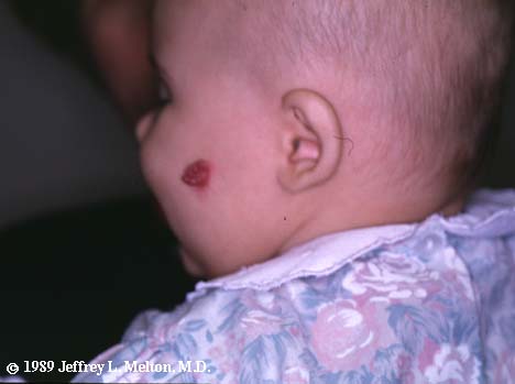 hemangioma on face. hemangioma of the Face