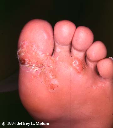 planters warts on feet. Plantar warts. Plantar refers