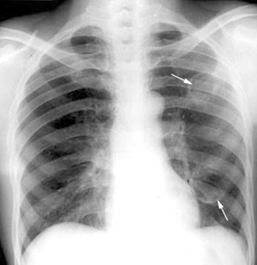 Aspergillus Cxr