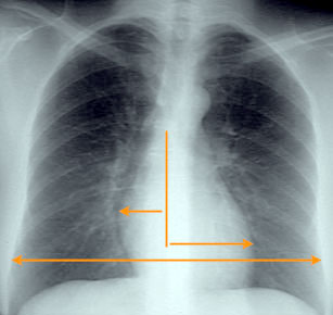 Chest x-ray as a diagnostic tool
