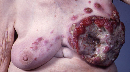 Papilloma Symptoms, Diagnosis, Treatments and Causes ...