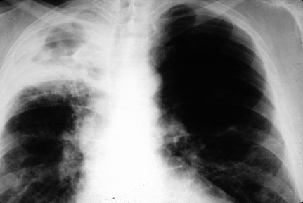 Granuloma Lung
