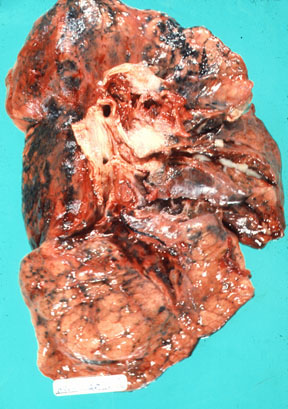 Bronchogenic Carcinoma Def