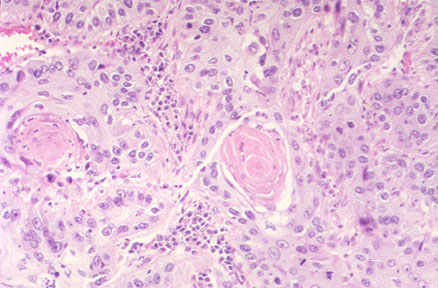 Carcinoma, squamous cell; Carcinoma, Epidermoid; Carcinoma
