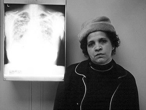 Sarcoid Cxr