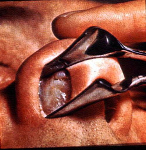obstruction; Nasal Polyps. www.meddean.luc.edu