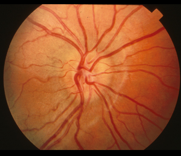 fundus exam findings funduscopic examination fundus exam findings funduscopic examination