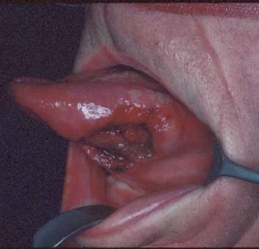 ulcers on tongue. Persistent ulcer or nodule