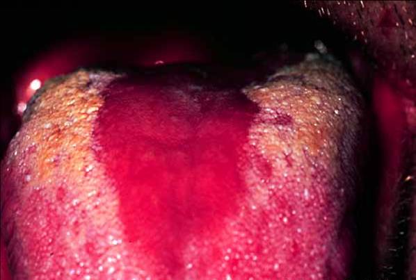 Glossitis