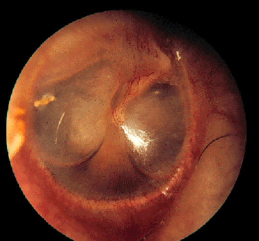 acute otitis media representation