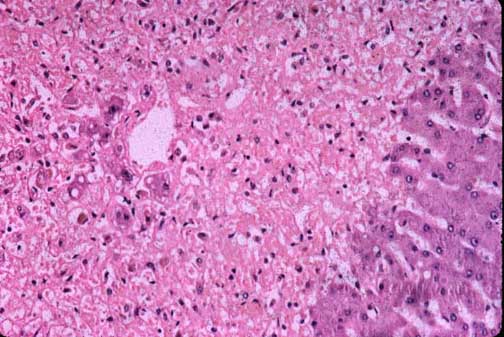 Coagulative Necrosis Heart
