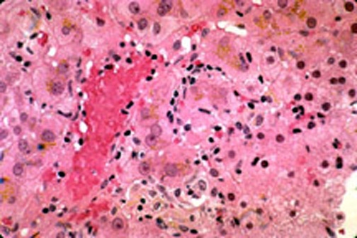 dilantin xanex