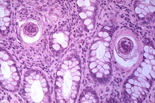 schistosomiasis pathology outlines)