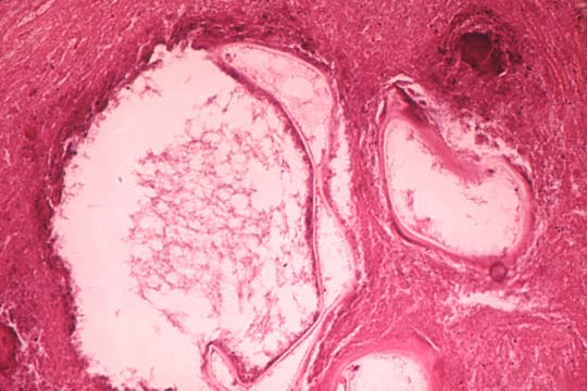 Section of daughter cysts cysts on dogs. Section of daughter cysts