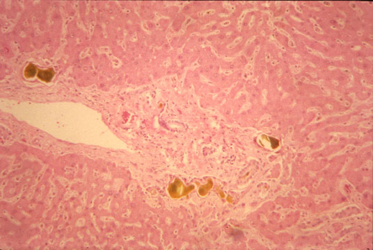 Cholestasis+pictures