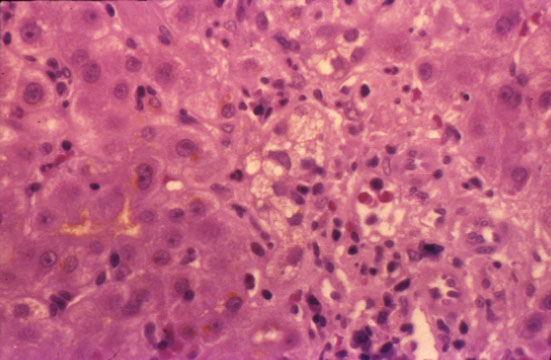 dilantin barbiturate