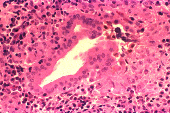 emit assay cirrhosis emit assay cirrhosis