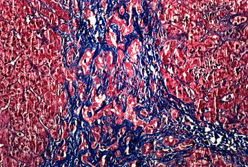 Bridging Fibrous Septa