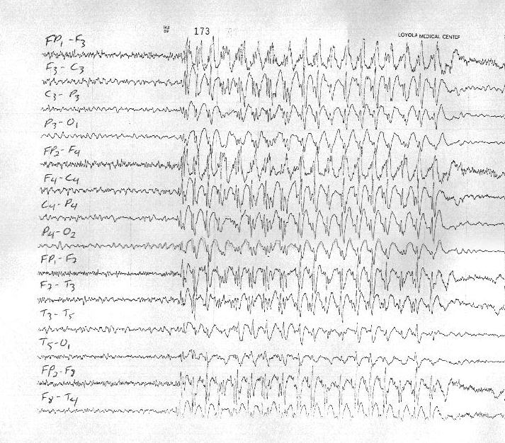 Absence Seizure