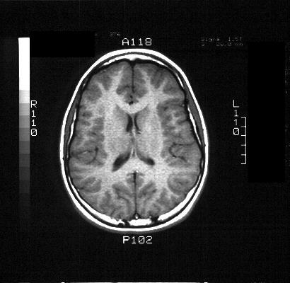 Funduscopic Exam