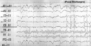EEG - case 1