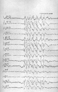 EEG - Case 2