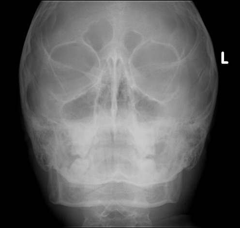 x ray sinuses