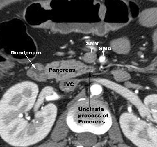 Labeled Abdominal Ct