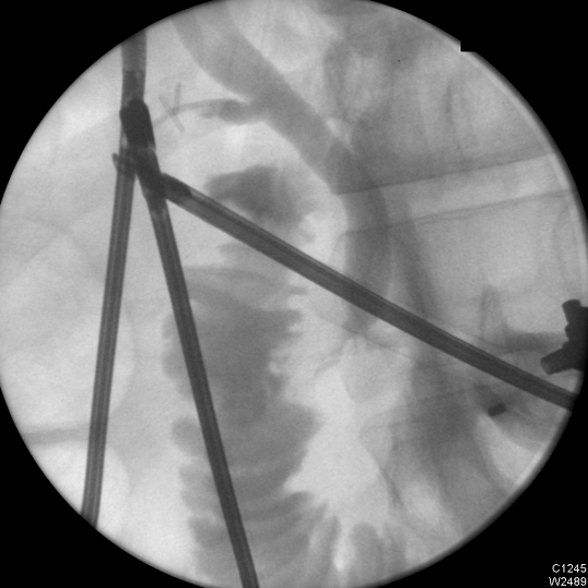 Endoscopic+cholangiogram 2011