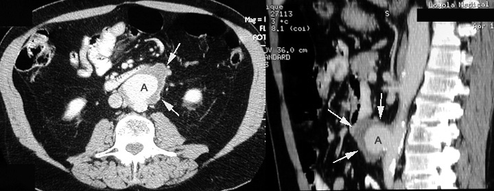 mycotic aneurysm