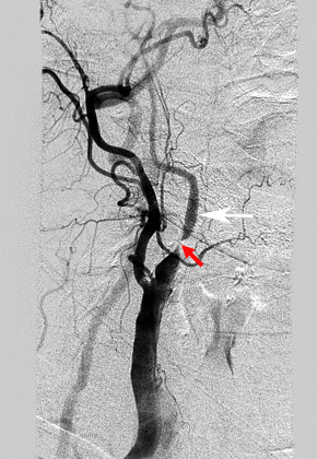 Internal carotid Artery