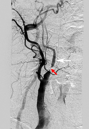 Internal carotid Artery Internal carotid Artery