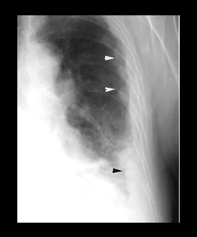 mesothelioma
