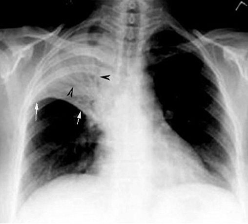 Pneumonia X Ray. What are the x-ray findings of