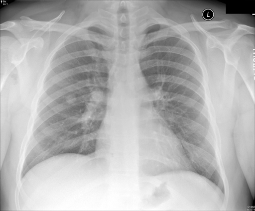 Cxr Male
