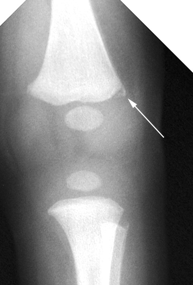 Femur: metaphyseal lipping of distal femur - corner fracture