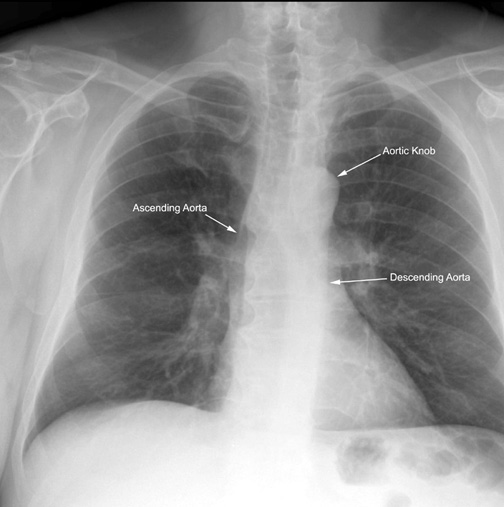 Pa Cxr