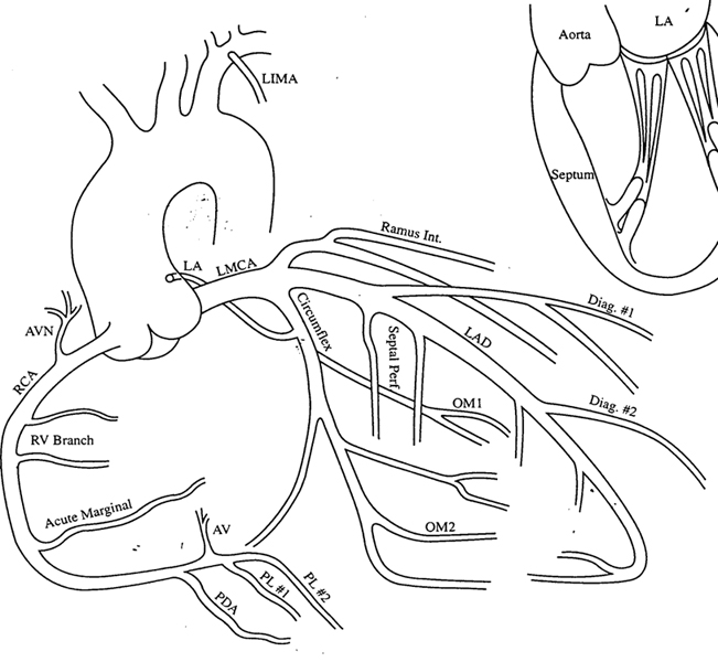 Branches, Drawing: Coronary artery and its branches