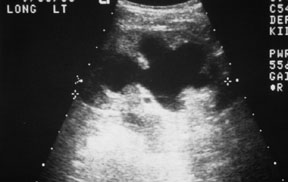 Kidney Ultrasound Nl Hydronephrosis