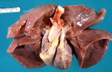 damaged lungs. The lungs extend down to the