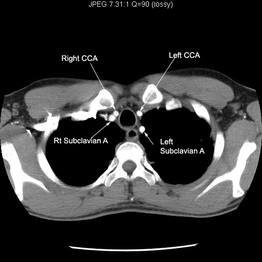 CT Scan Tips & Protocols CT upper chest anatomy