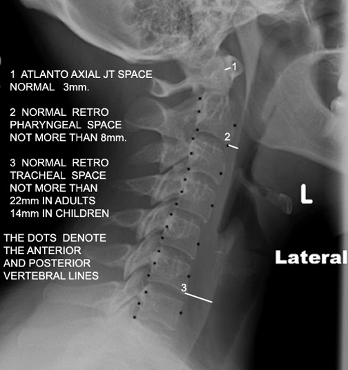 causes of retropharyngeal cellulitis