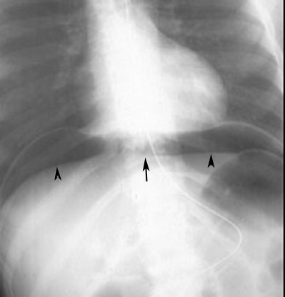 Free Air Abdomen